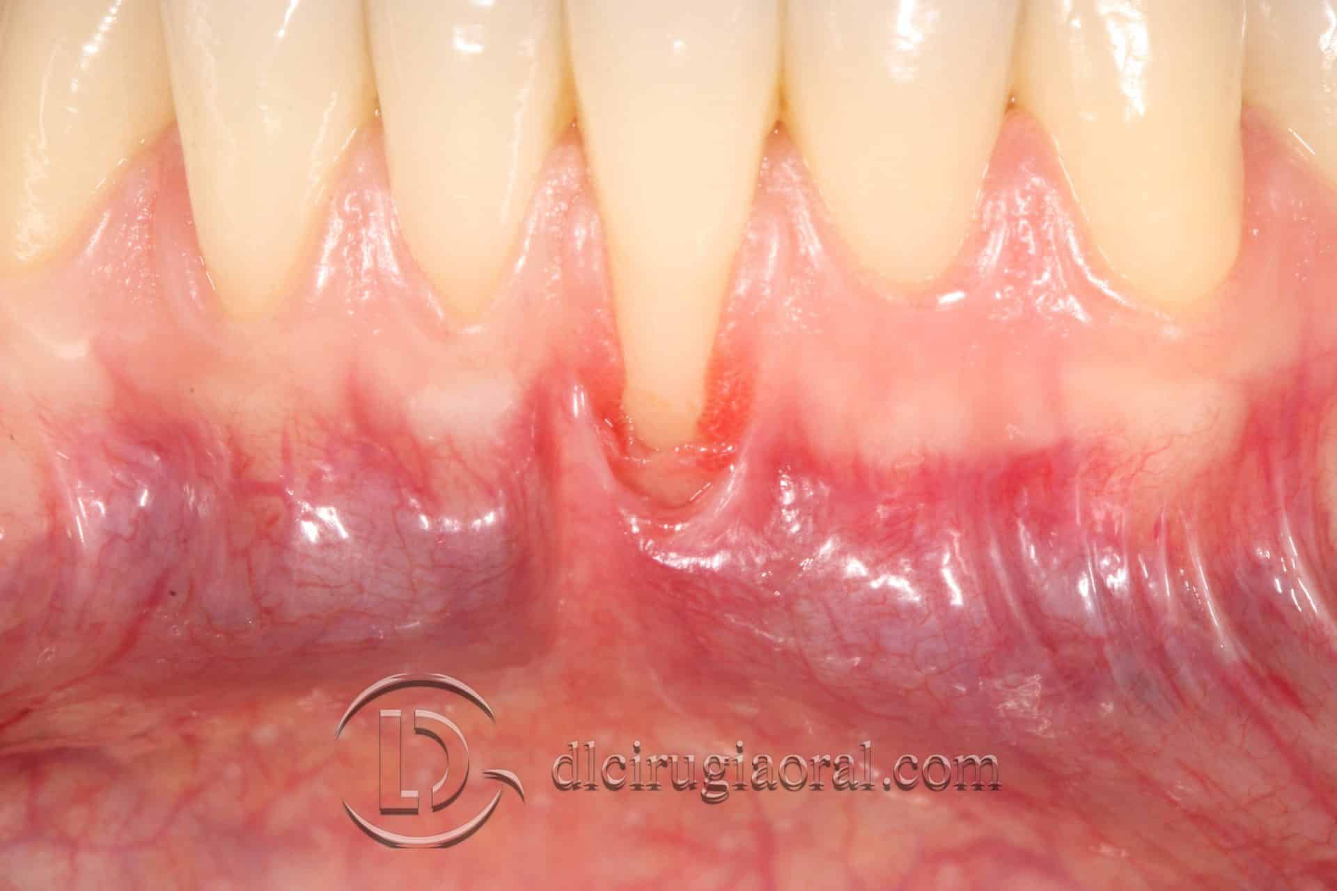 Recesión dental y su tratamiento con injerto de tejido conectivo