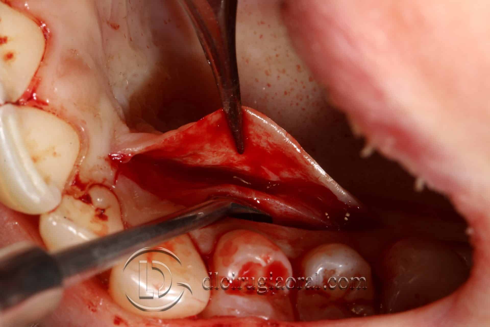 tratamiento recesión dental