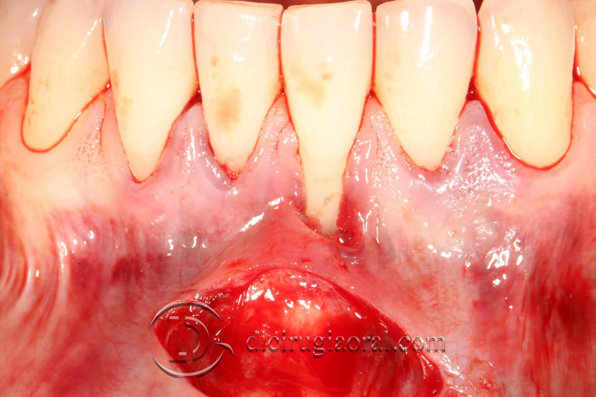 tratamiento recesión dental