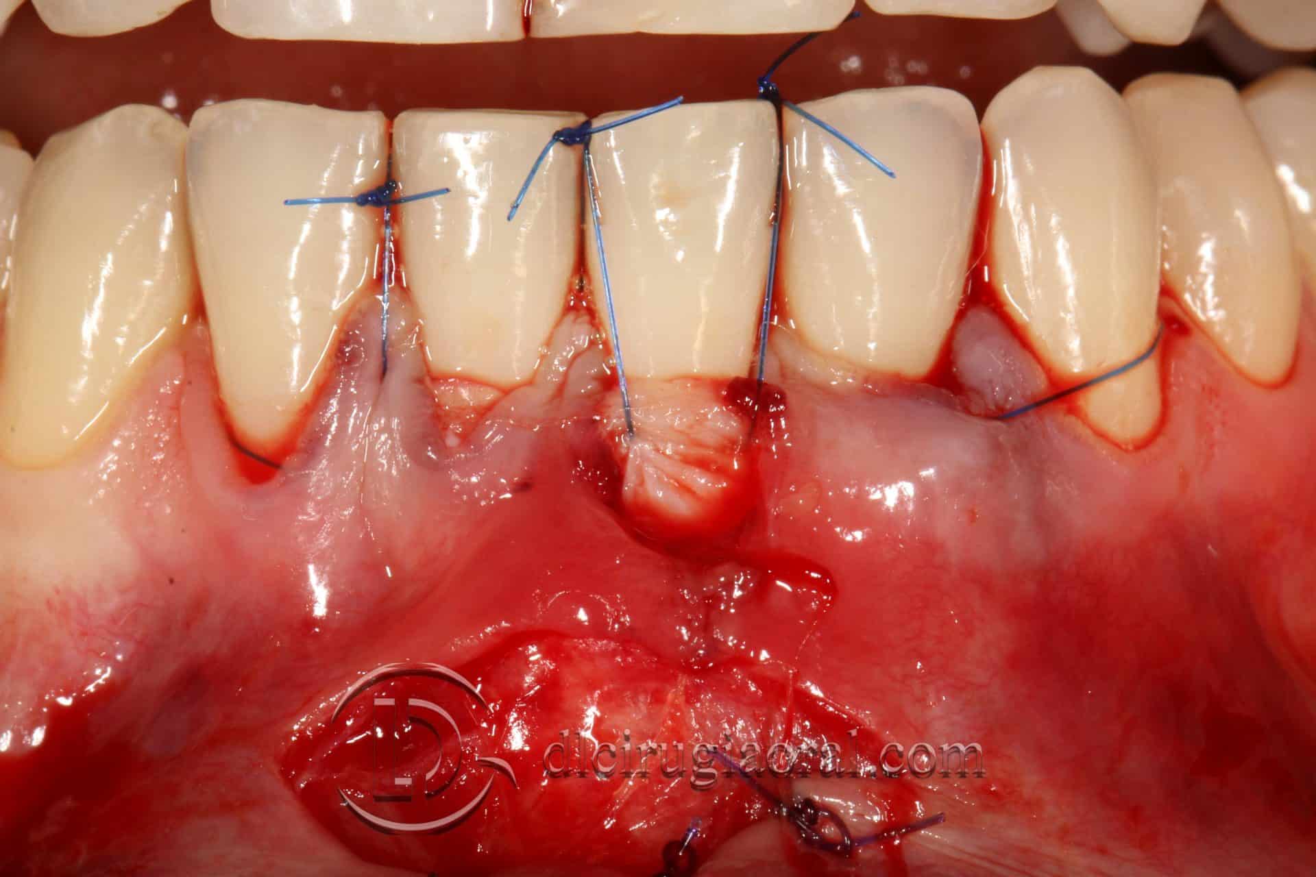 tratamiento recesión dental