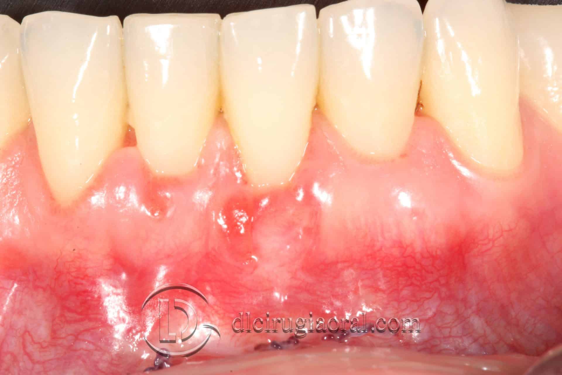 tratamiento recesión dental