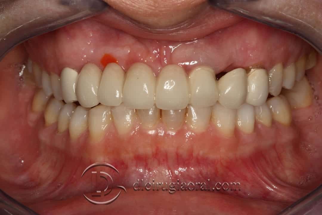 Reconstrucción Ósea con Tecnica de Khoury