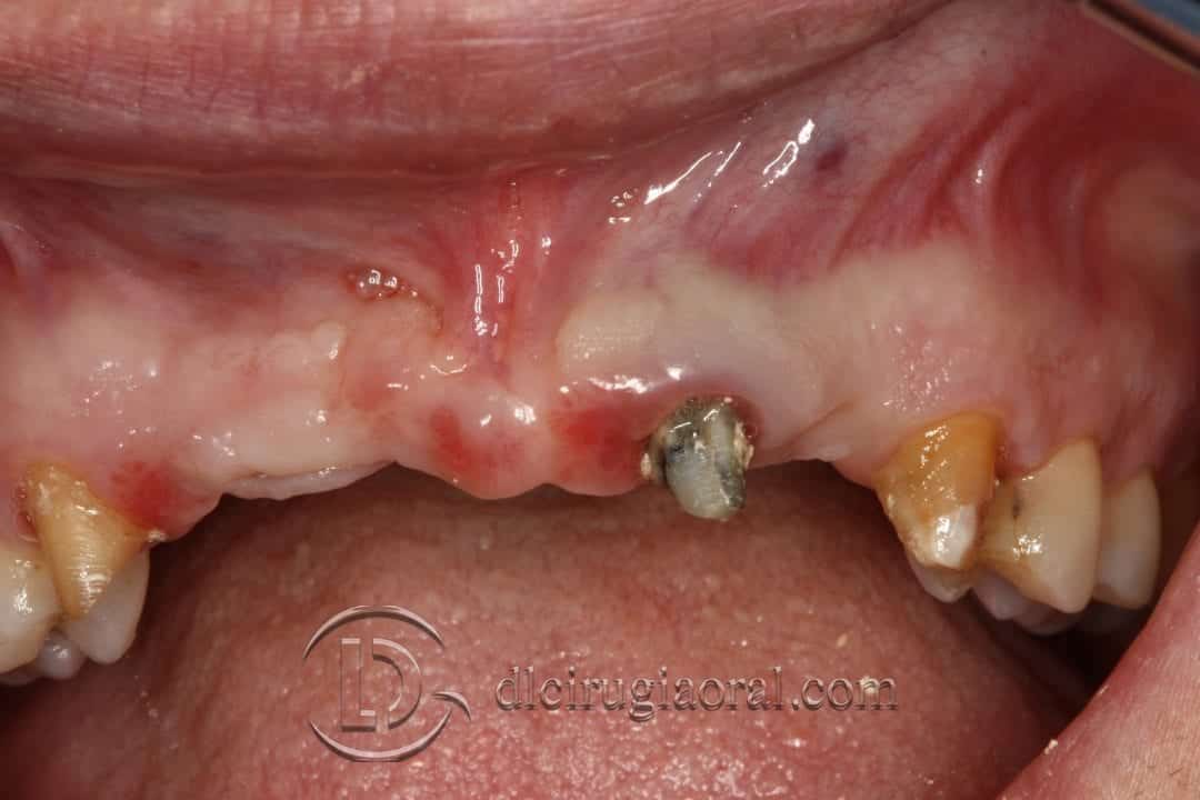Reconstrucción Ósea con Tecnica de Khoury