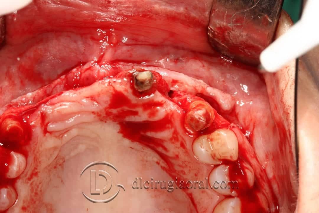 Reconstrucción Ósea con Tecnica de Khoury