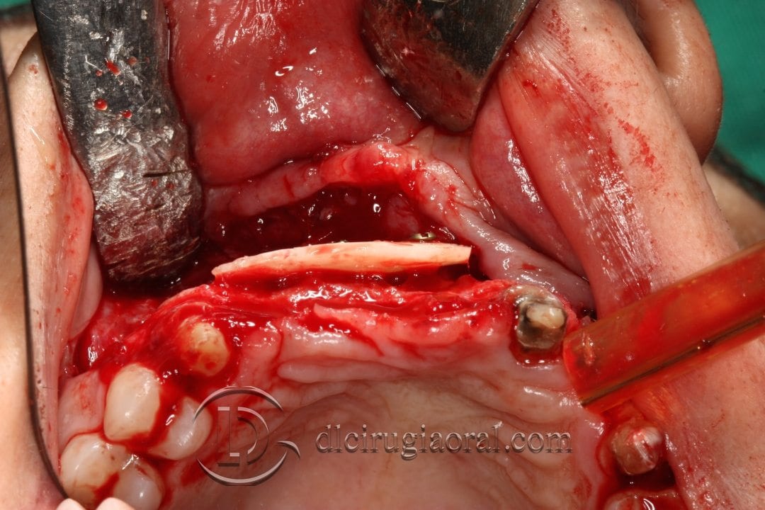colocación de implantes en sector anterior