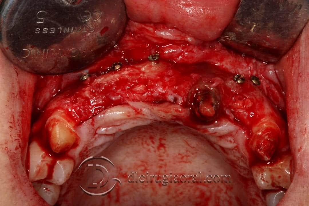 Reconstrucción Ósea con Tecnica de Khoury