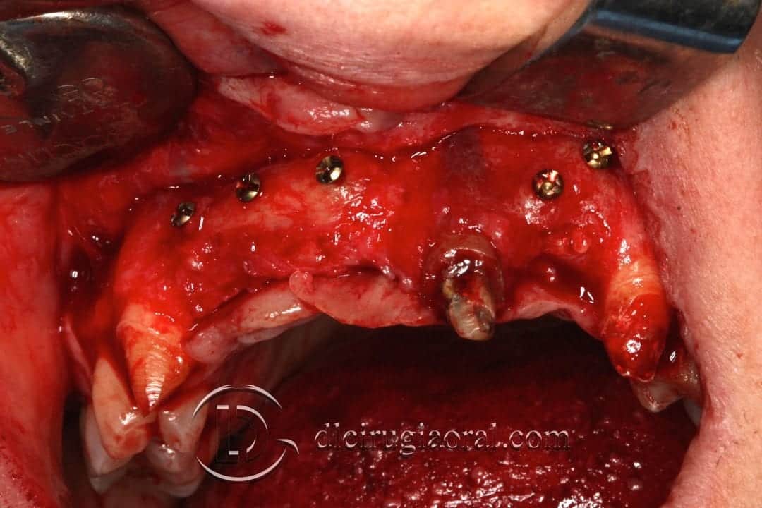 Colocación de implantes en sector anterior tras reconstrucción ósea