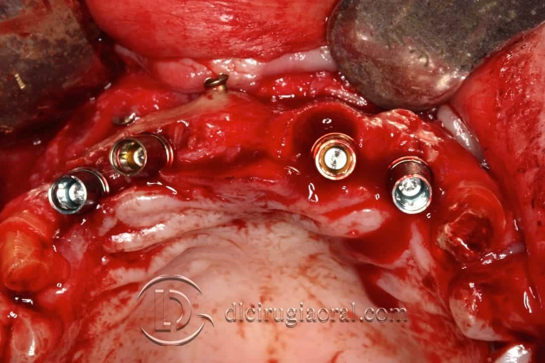 colocación de implantes en sector anterior