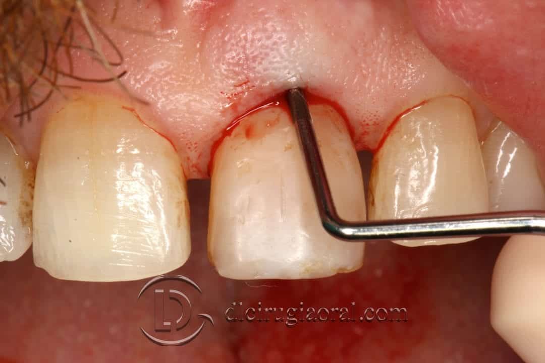 Socket Preservation