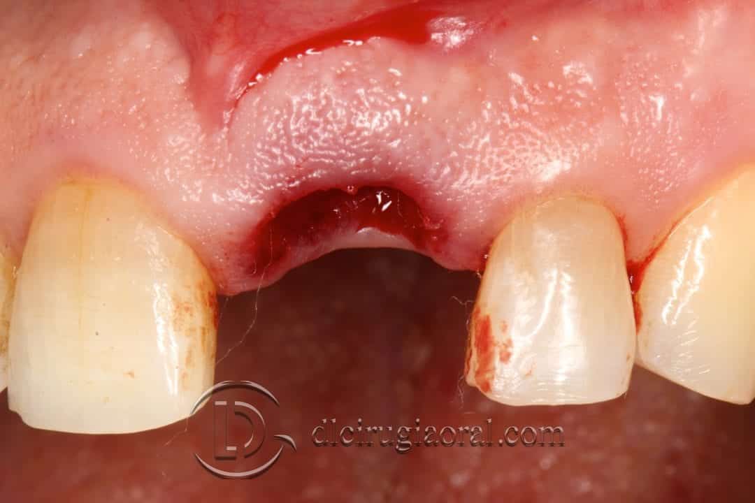 Socket Preservation