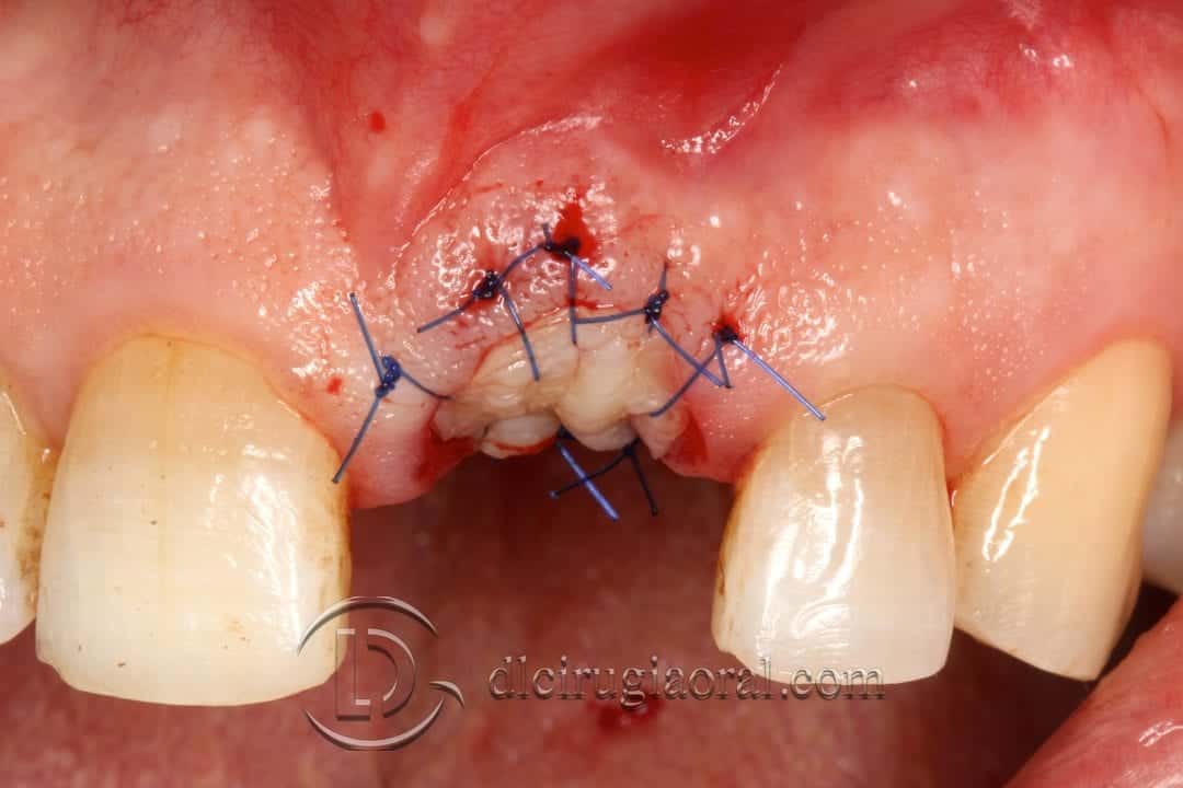 Socket Preservation