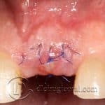 Socket Preservation
