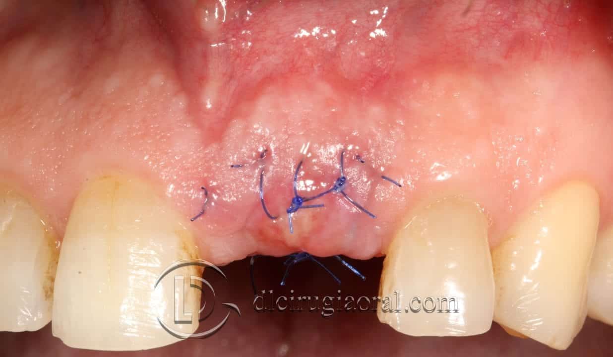 Socket Preservation: Ausencia de tabla vestibular en frente estético