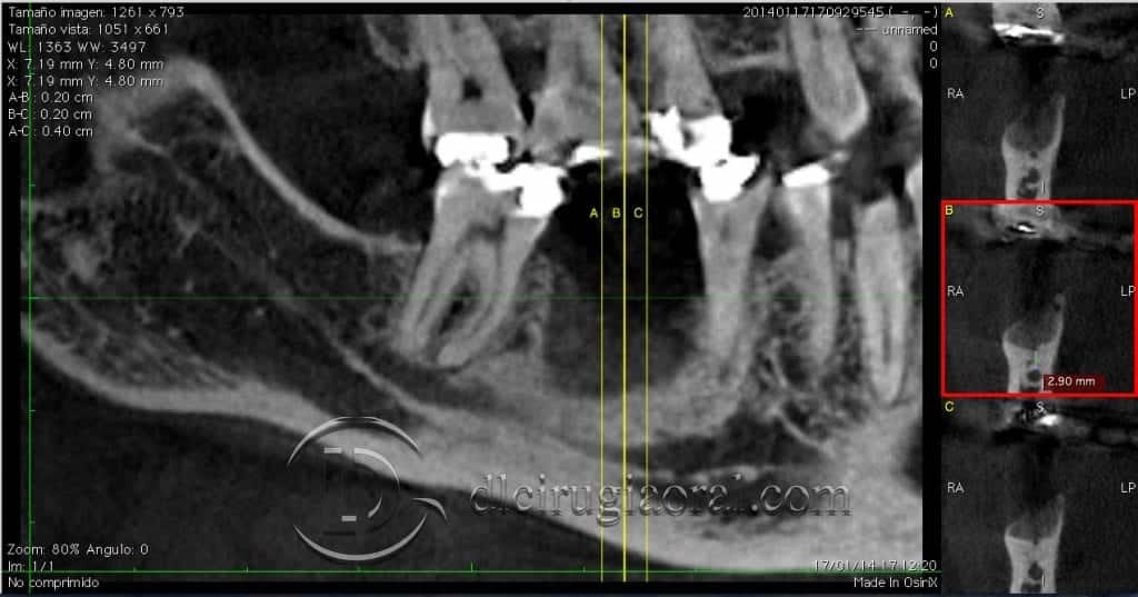 reconstrucción de defecto vertical en mandíbula