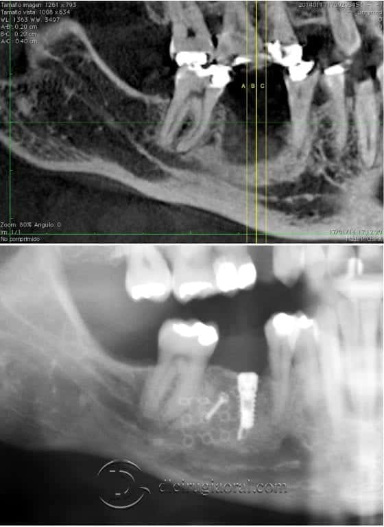 reconstrucción de defecto vertical en mandíbula