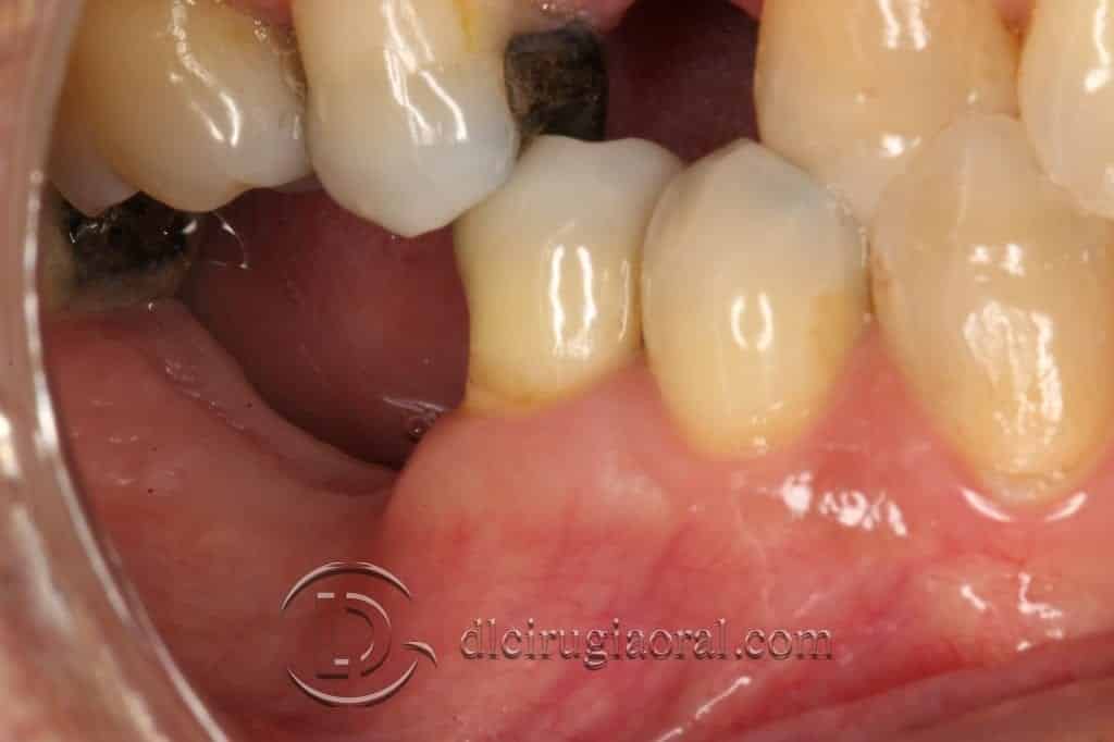 reconstrucción de defecto vertical en mandíbula