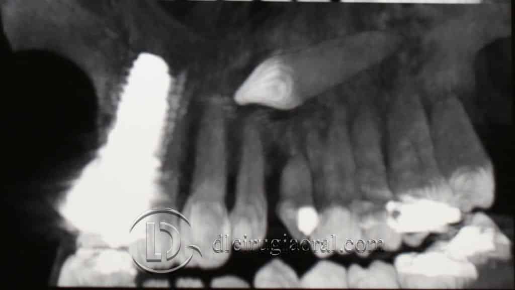 Manejo del canino incluido en implantología oral: exodoncia + implante + injerto