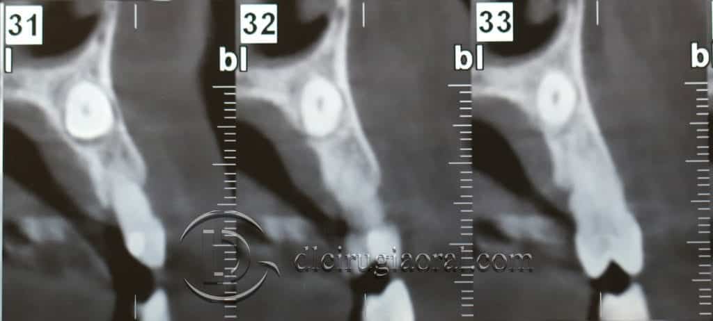 Manejo del canino incluido en implantología oral