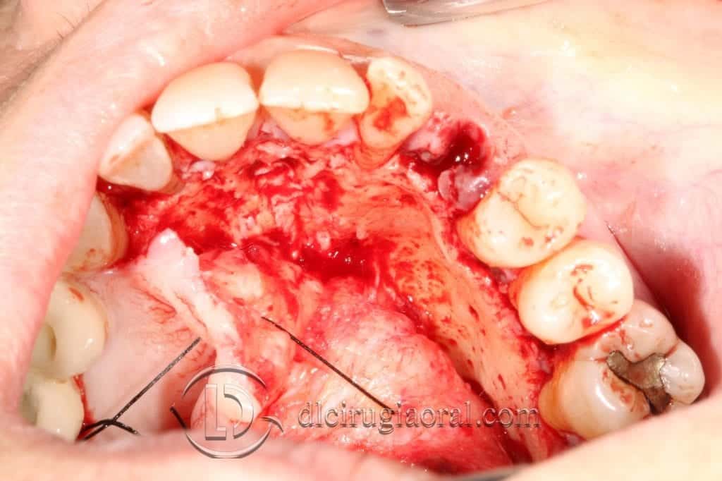 Manejo del canino incluido en implantología oral