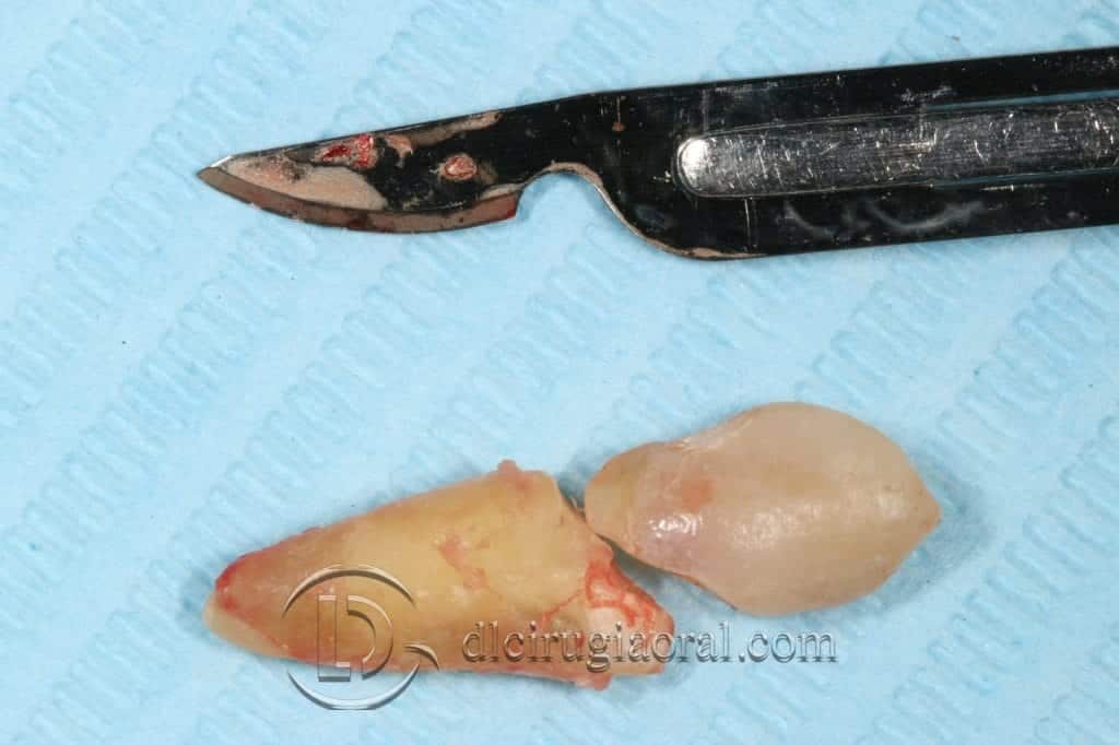 Manejo del canino incluido en implantología oral