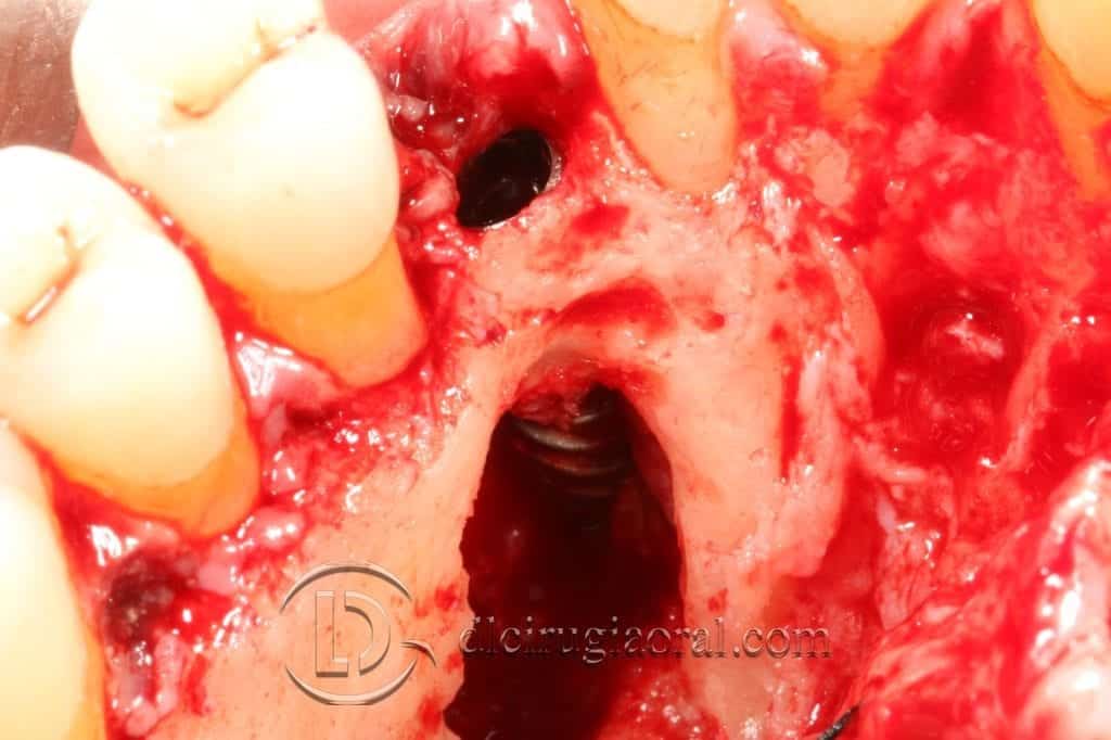 Manejo del canino incluido en implantología oral