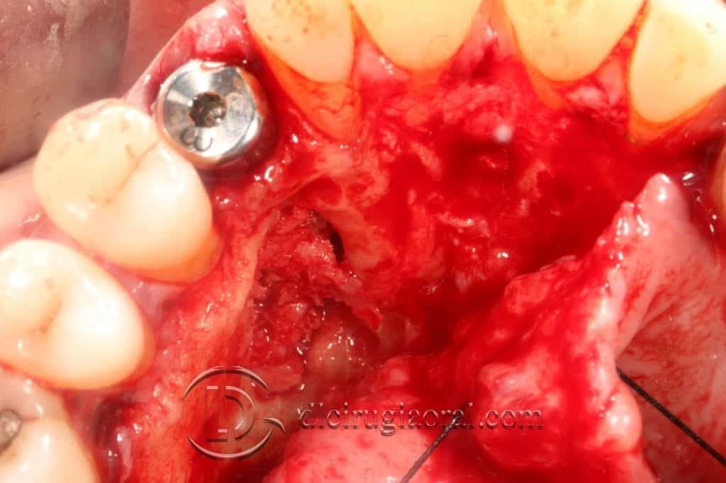 Manejo del canino incluido en implantología oral