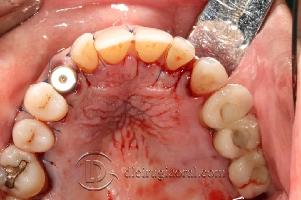 Manejo del canino incluido en implantología oral