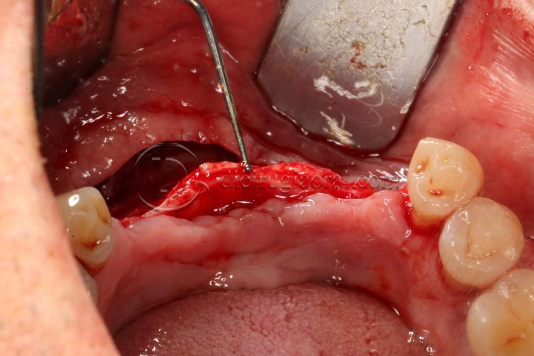 Regeneración de defecto óseo horizontal en la mandíbula anterior