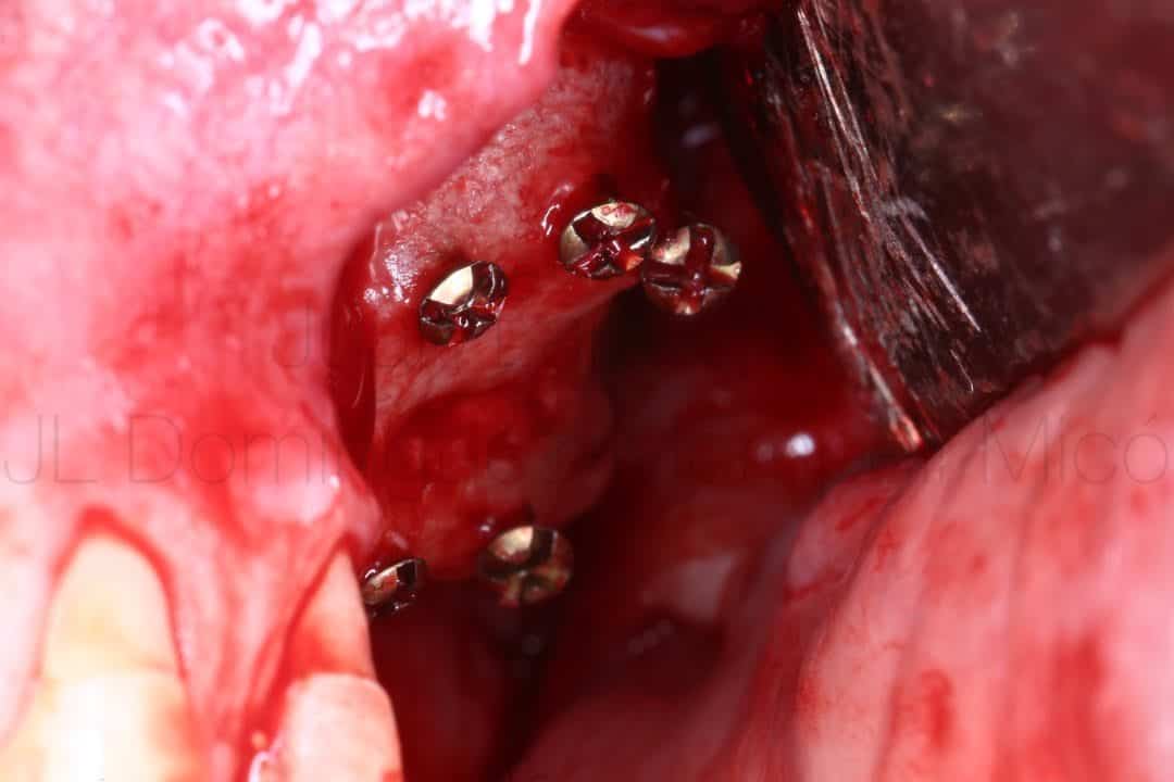 reconstrucción ósea maxilar