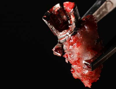 Tratamiento del Implante fracturado