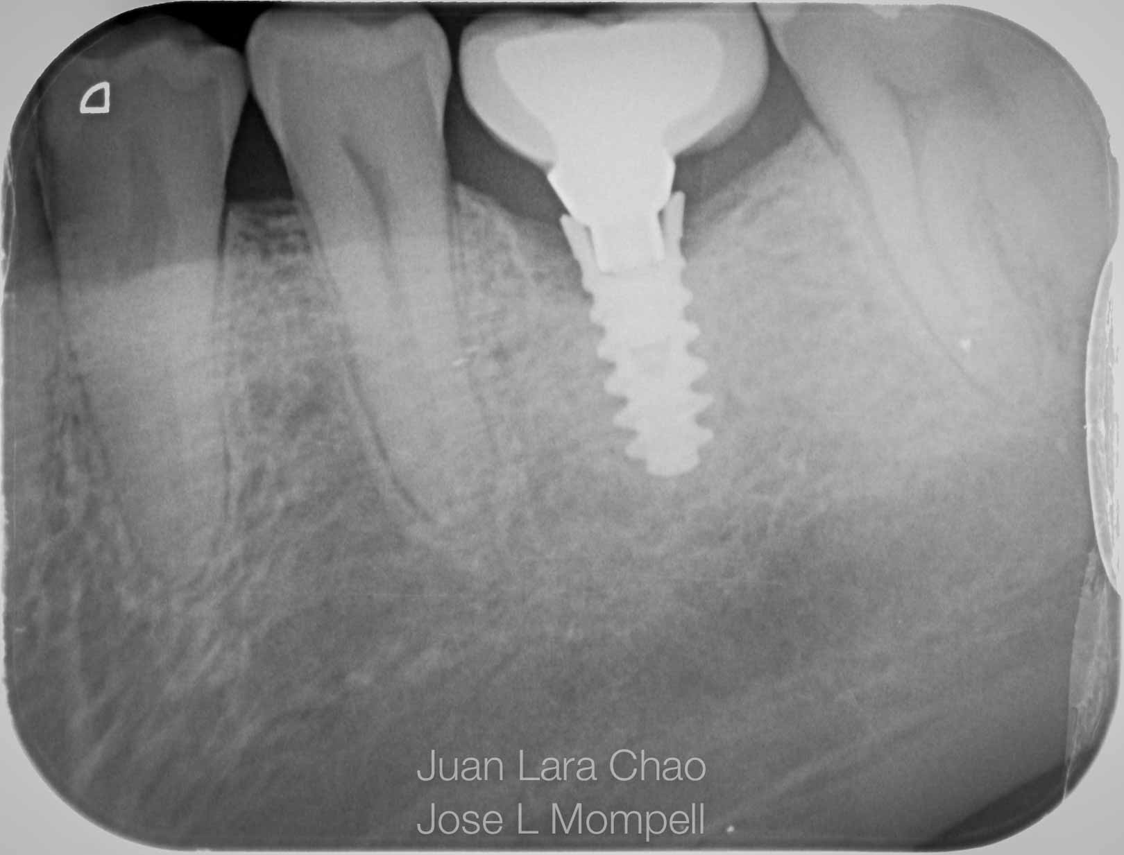 Tratamiento del Implante fracturado