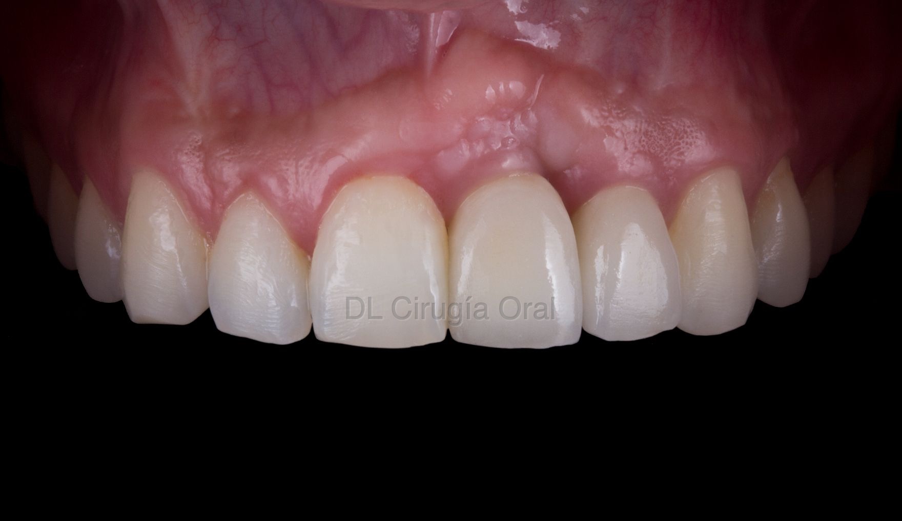 Pérdida de Implante Dental