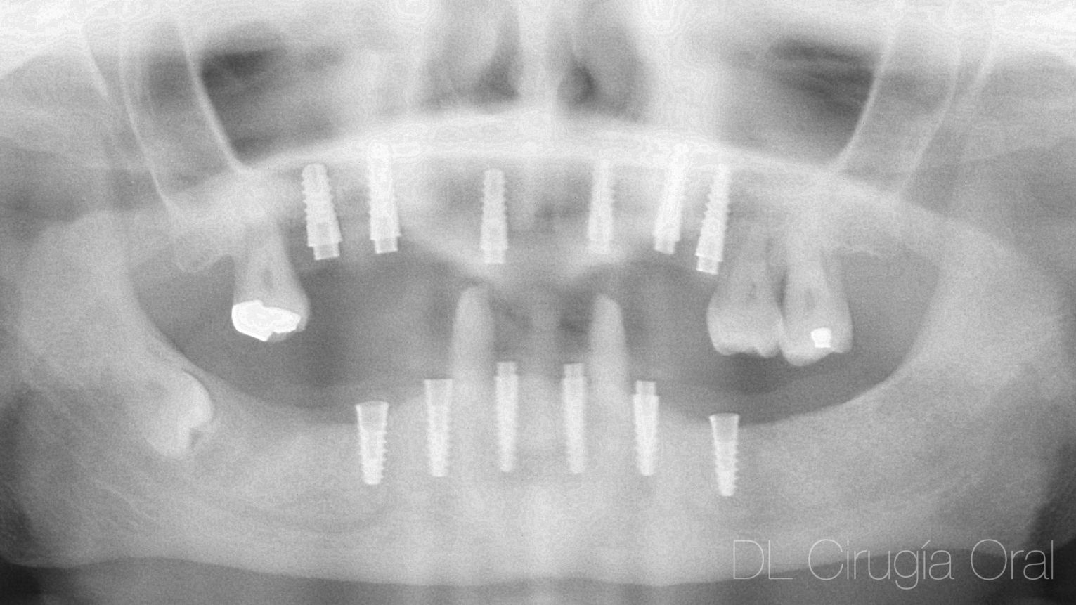 servicio de colocación de implantes para clínicas dentales