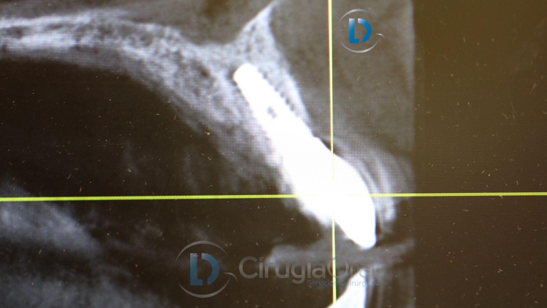 Implante dental en sector anterior
