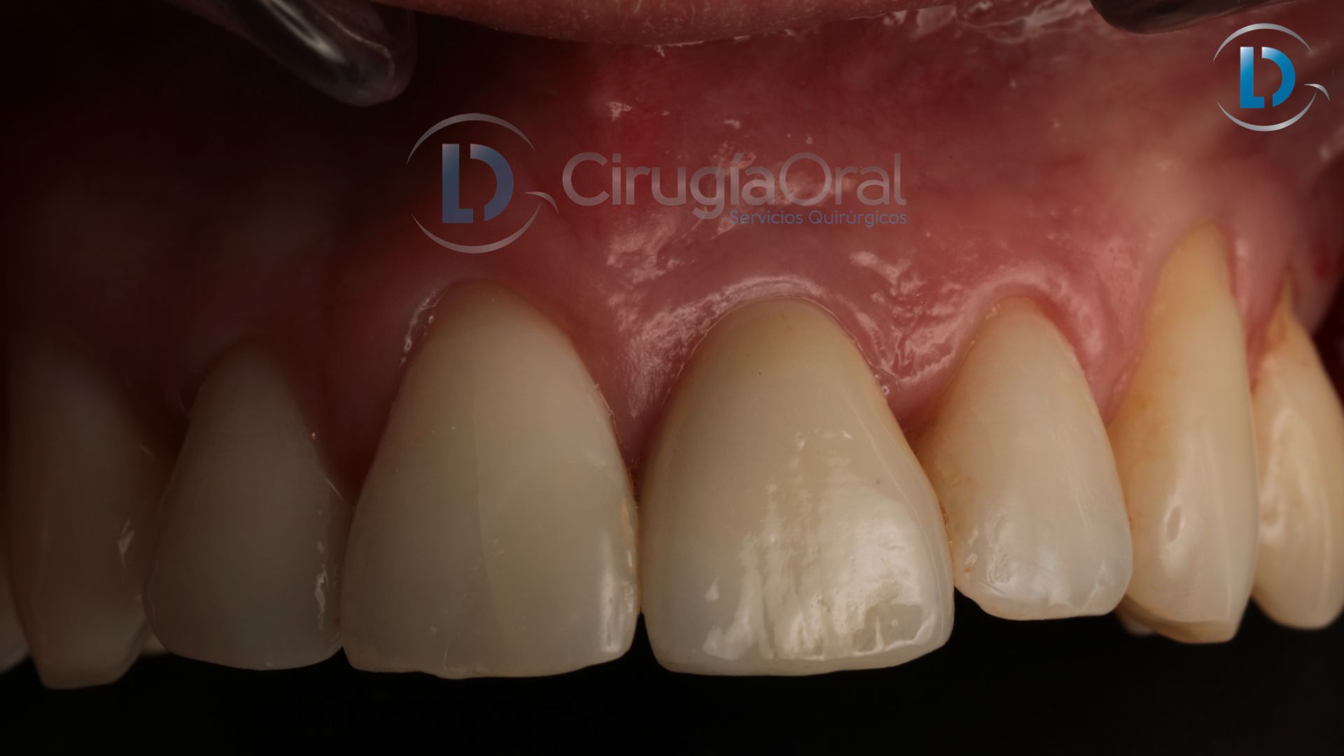Implante dental en sector anterior