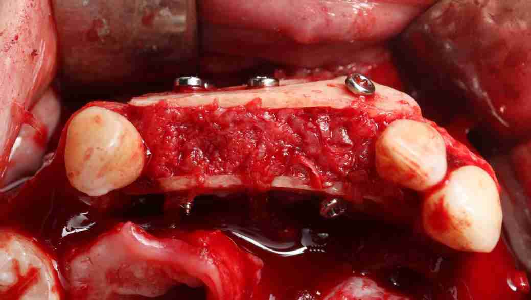 Cirugía oral avanzada: reconstrucción ósea y formación para casos complejos