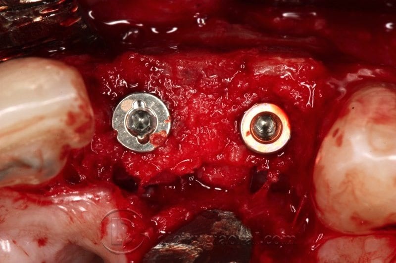 Cirugía de implantes sobre reconstrucción en frente anterior